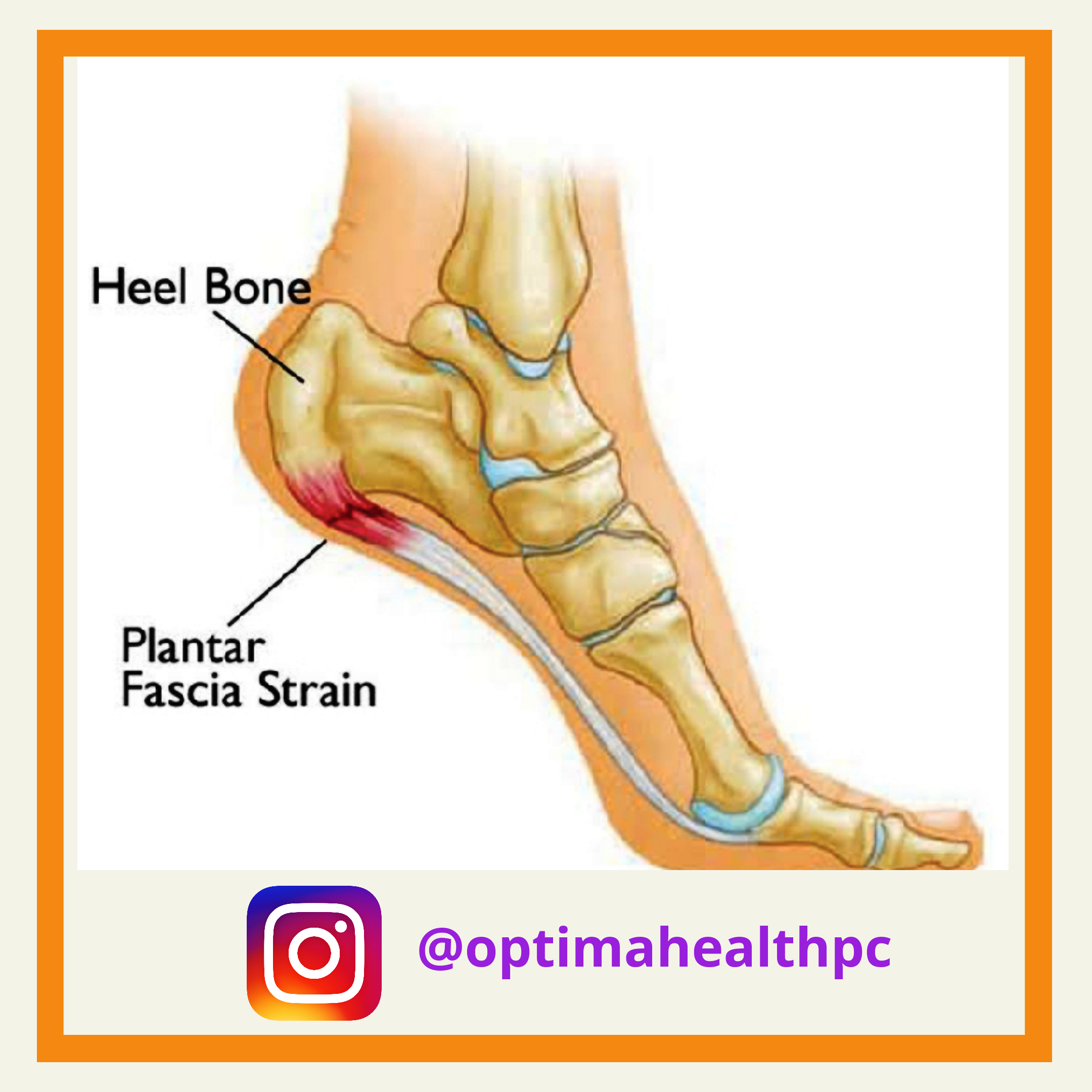 Physical Therapy For Plantar Fasciitis Pain - PTandMe