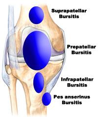 Knee Bursitis