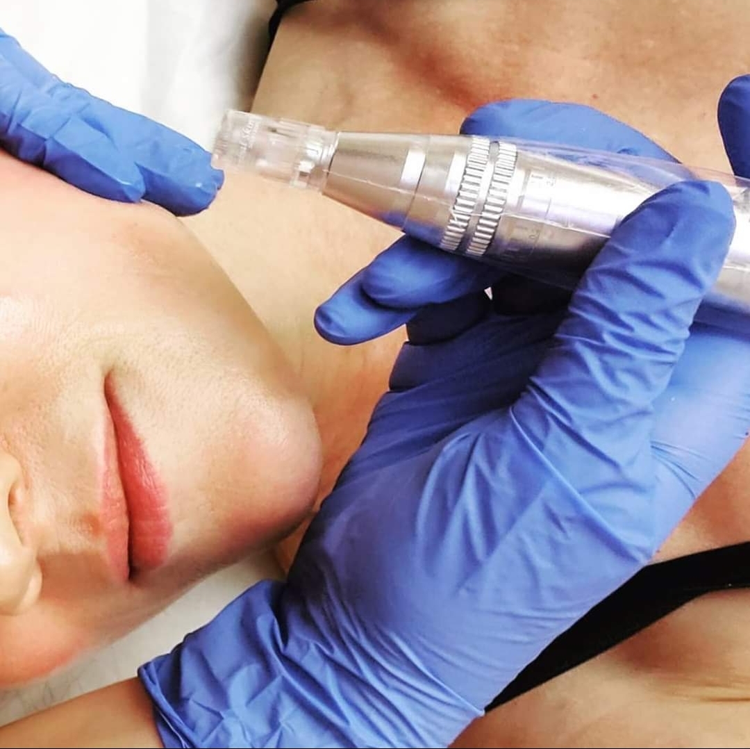 MicroNeedling Collagen Induction Therapy