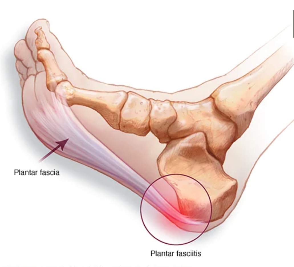 Foot Pain Diagram - Why Does My Foot Hurt?