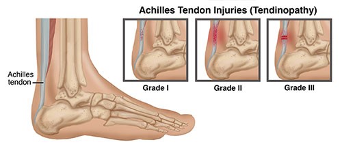 Physiotherapy Guide to Achilles Tendinopathy