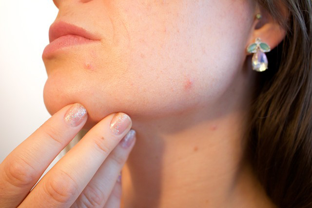 CBD Oil for Acne: What You Need to Know