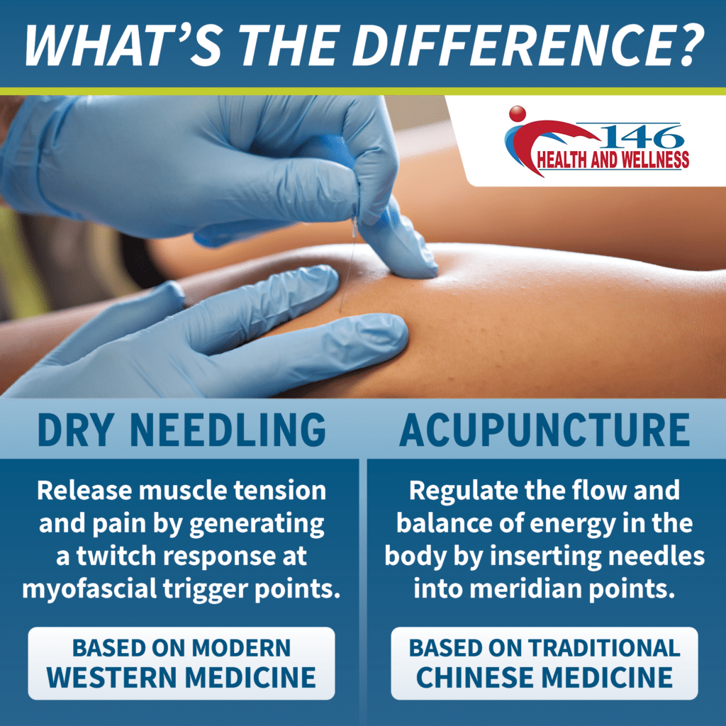 10 Things you need to know about Dry Needling