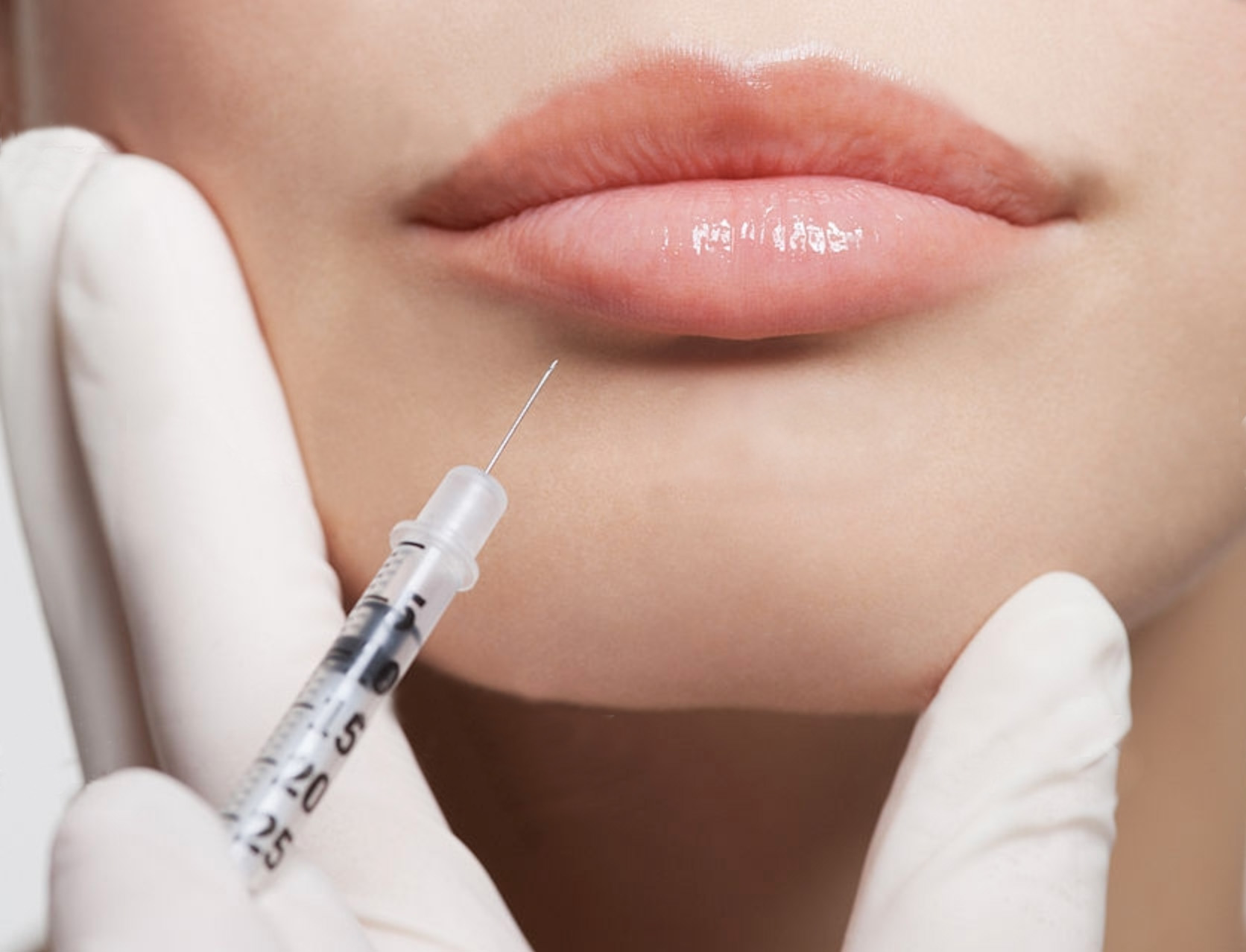 Lip Flips, lip fillers—full and half-syringes